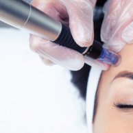 Microneedling